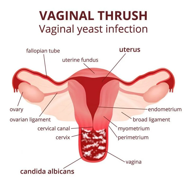 vaginal thrush